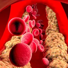 Wysoki cholesterol: Cichy zabójca? Poznaj przyczyny i skuteczne metody
