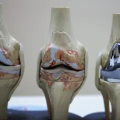 Modele anatomiczne kolan: zdrowe, z uszkodzeniami i po zabiegu z endoprotezą kolana.
