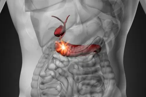Wizualizacja przedstawia trzustkę i woreczek żółciowy. Ból w okolicy trzustki może sugerować konieczność usunięcia woreczka żółciowego.