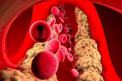 Wysoki cholesterol: Cichy zabójca? Poznaj przyczyny i skuteczne metody