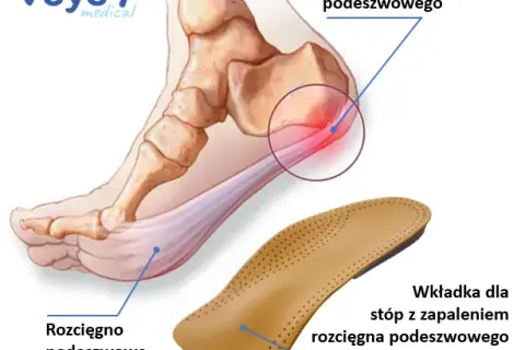 Zapalenie powięzi podeszwy: Leki na ból pięty co naprawdę pomaga?