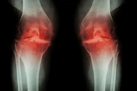 RTG kolan z zaznaczonymi zmianami zapalnymi. Widoczne zwężenie przestrzeni stawowych, sugerujące chorobę zwyrodnieniową, która może wymagać osteotomii.