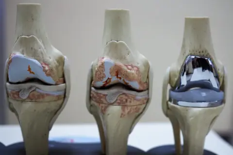 Modele anatomiczne kolan: zdrowe, z uszkodzeniami i po zabiegu z endoprotezą kolana.