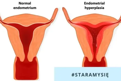 Porównanie prawidłowego endometrium z przerostem. Biopsja endometrium jest kluczowa w diagnostyce.