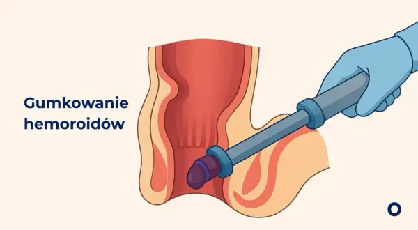 Ilustracja przedstawia zabieg gumkowania hemoroidów. Ręka w niebieskiej rękawiczce używa narzędzia do założenia gumki na hemoroid.