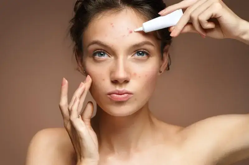 Kiedy iść do dermatologa z trądzikiem, konsultacja dermatologiczna trądzik