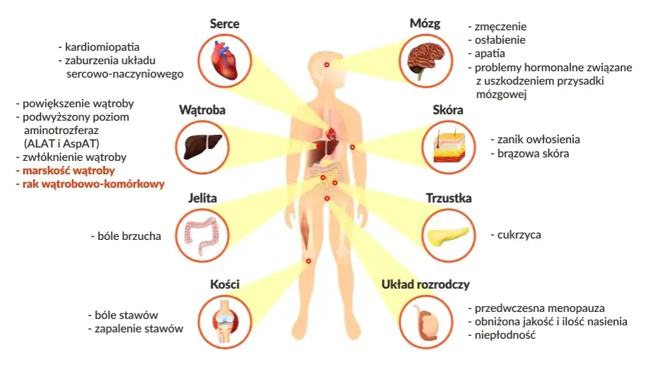 Przyczyny nadmiaru żelaza w organizmie infografika