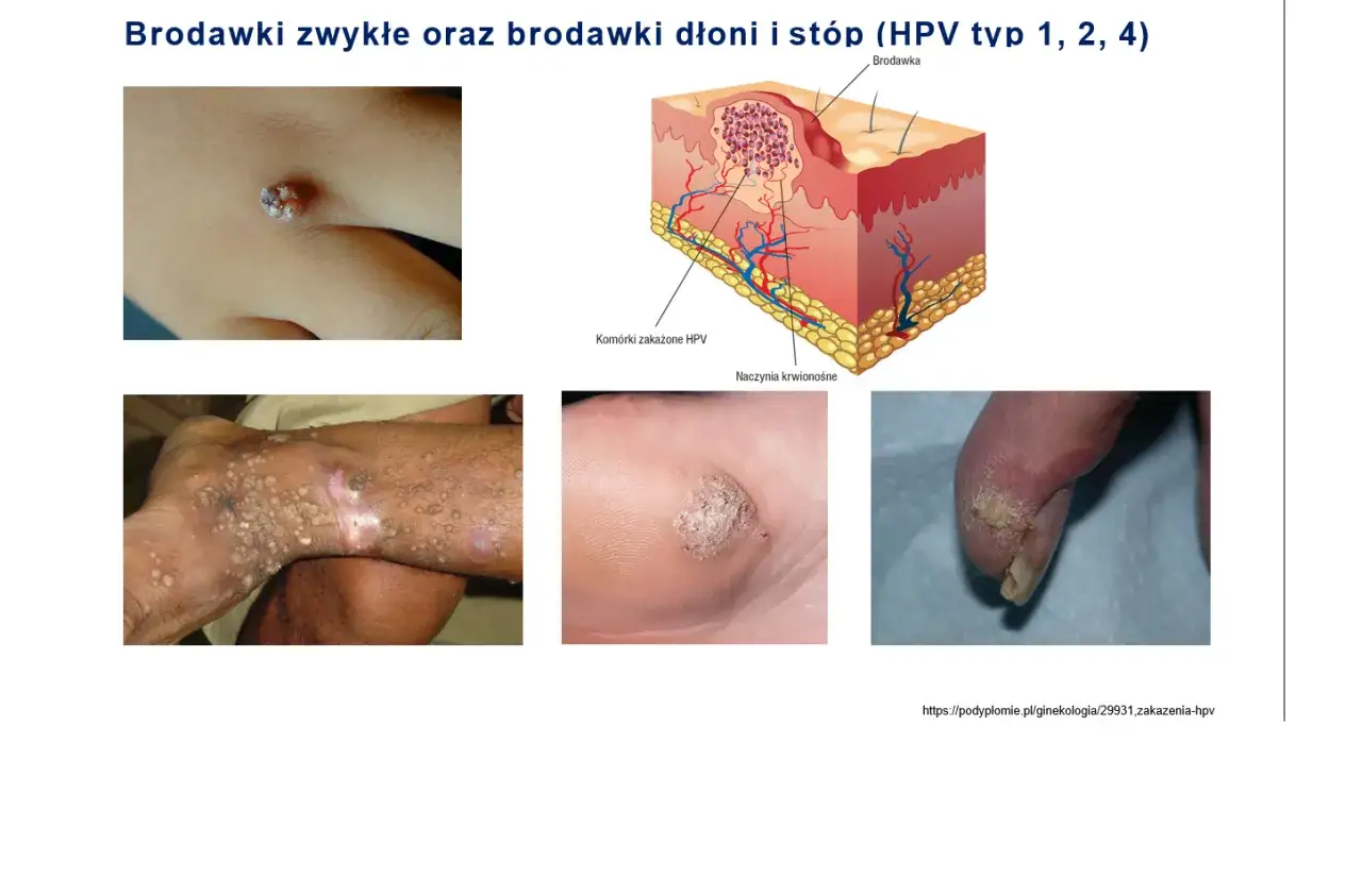 różnica między kurzajką a kłykciną grafika