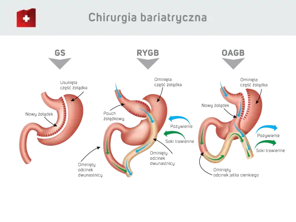 Ilustracja przedstawia trzy typy operacji bariatrycznej: GS, RYGB i OAGB, pokazując zmiany w żołądku i jelitach.