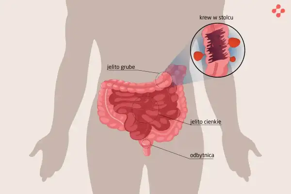 Ilustracja przedstawia jelita z widoczną krwią w stolcu w okolicy odbytnicy.