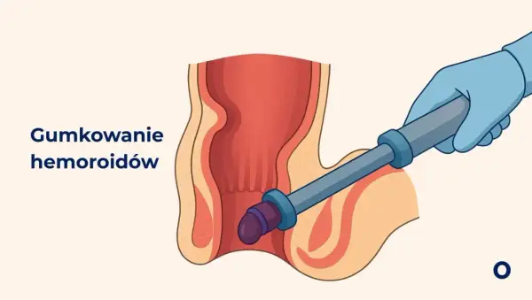 Ilustracja przedstawia zabieg gumkowania hemoroidów. Ręka w niebieskiej rękawiczce używa narzędzia do założenia gumki na hemoroid.