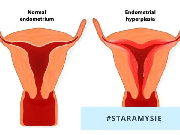 Porównanie prawidłowego endometrium z przerostem. Biopsja endometrium jest kluczowa w diagnostyce.